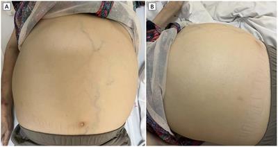 Applying enhanced recovery after surgery protocols in a patient with a giant spleen: a case report